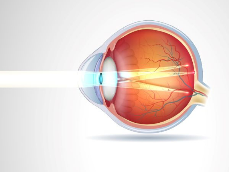 Défaut Astigmatisme 39241473_xl Représentation de l'astigmatisme
