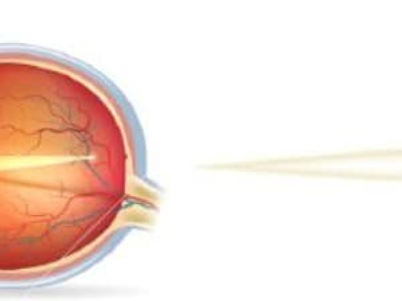 les différents défauts de vision